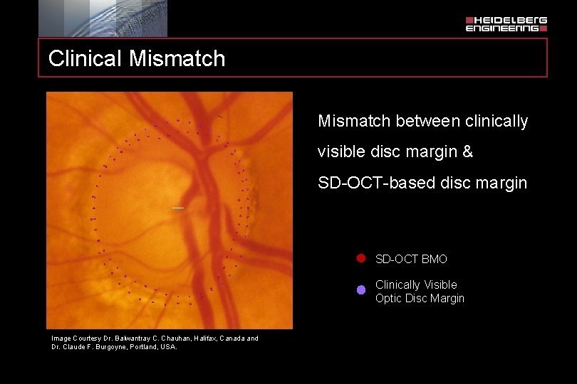 Clinical Mismatch between clinically visible disc margin & SD-OCT-based disc margin SD-OCT BMO Clinically