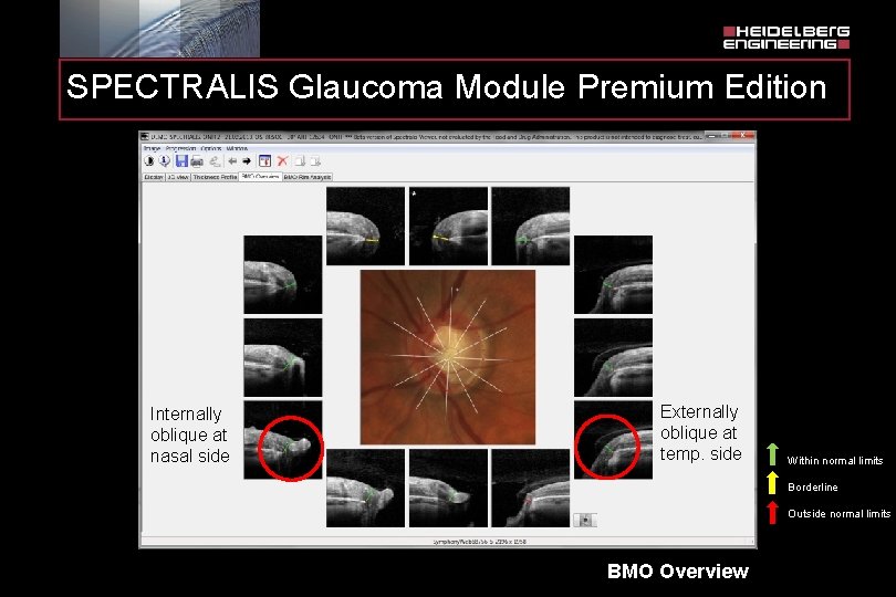 SPECTRALIS Glaucoma Module Premium Edition Internally oblique at nasal side Externally oblique at temp.