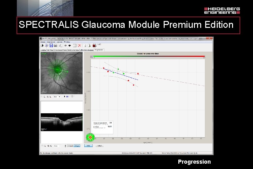 SPECTRALIS Glaucoma Module Premium Edition Progression 