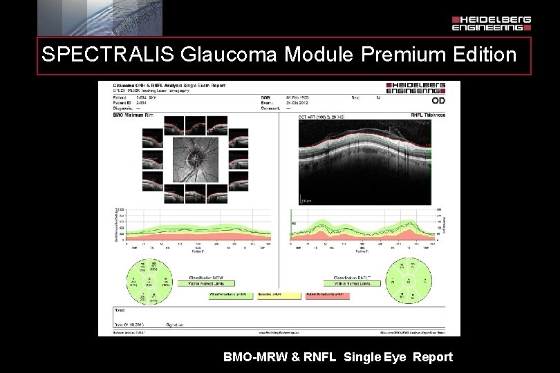 SPECTRALIS Glaucoma Module Premium Edition BMO-MRW & RNFL Single Eye Report 