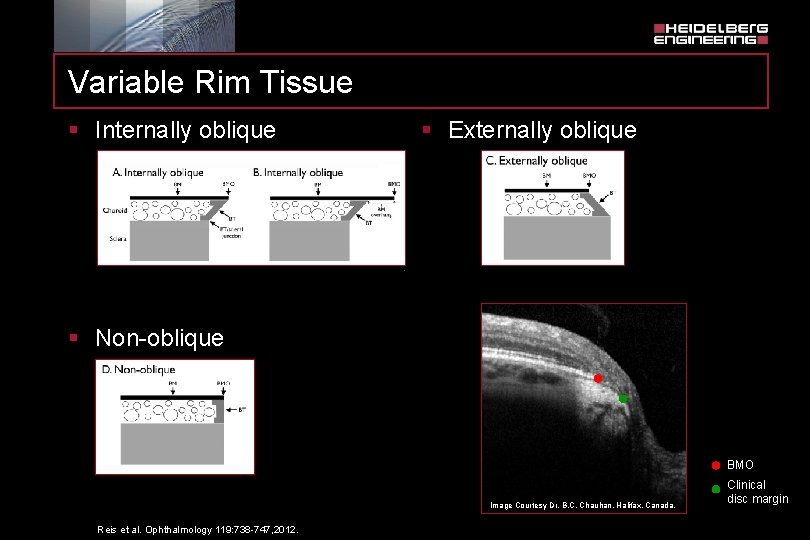 Variable Rim Tissue § Internally oblique § Externally oblique § Non-oblique BMO Image Courtesy
