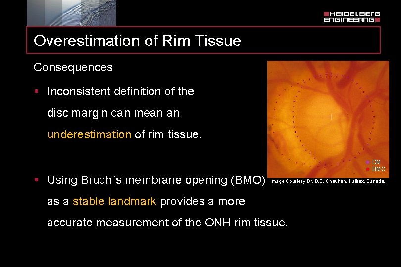 Overestimation of Rim Tissue Consequences § Inconsistent definition of the disc margin can mean