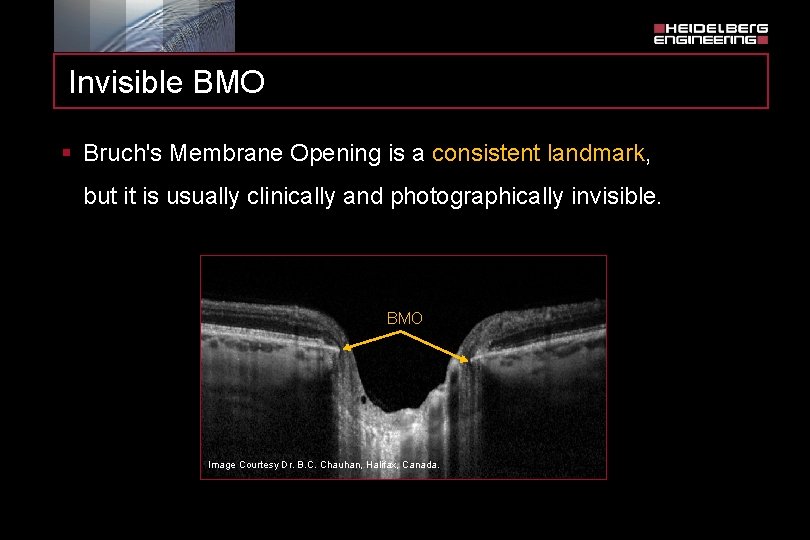 Invisible BMO § Bruch's Membrane Opening is a consistent landmark, but it is usually