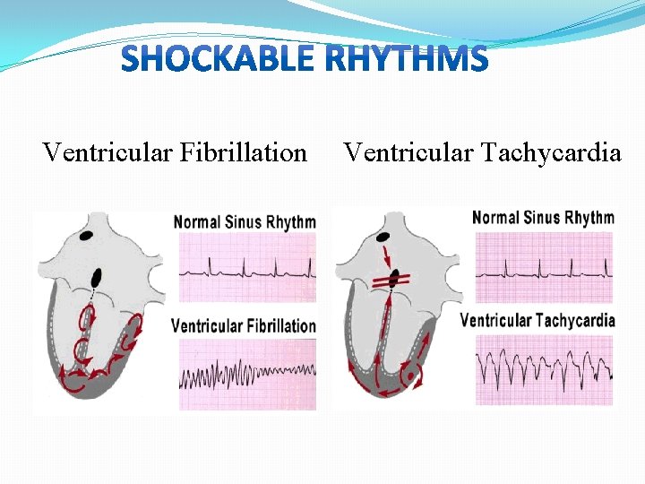 Ventricular Fibrillation Ventricular Tachycardia 