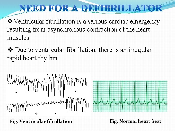 v. Ventricular fibrillation is a serious cardiac emergency resulting from asynchronous contraction of the