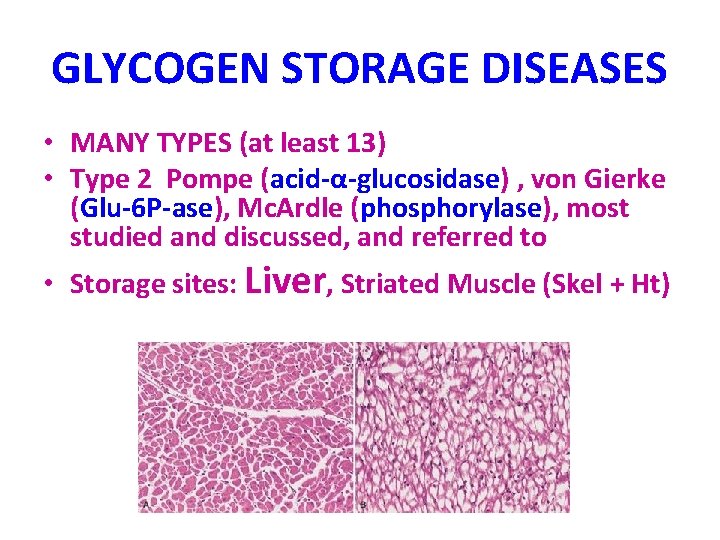 GLYCOGEN STORAGE DISEASES • MANY TYPES (at least 13) • Type 2 Pompe (acid-α-glucosidase)