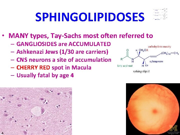SPHINGOLIPIDOSES • MANY types, Tay-Sachs most often referred to – GANGLIOSIDES are ACCUMULATED –