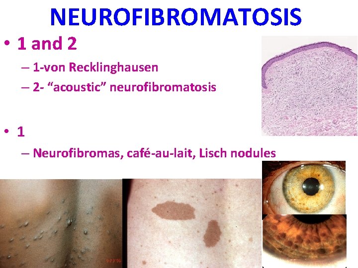 NEUROFIBROMATOSIS • 1 and 2 – 1 -von Recklinghausen – 2 - “acoustic” neurofibromatosis