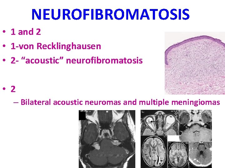 NEUROFIBROMATOSIS • 1 and 2 • 1 -von Recklinghausen • 2 - “acoustic” neurofibromatosis