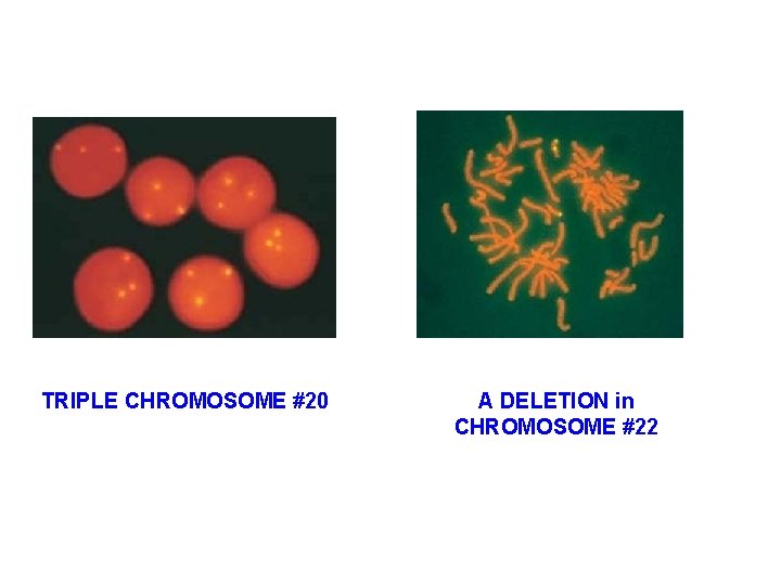 TRIPLE CHROMOSOME #20 A DELETION in CHROMOSOME #22 