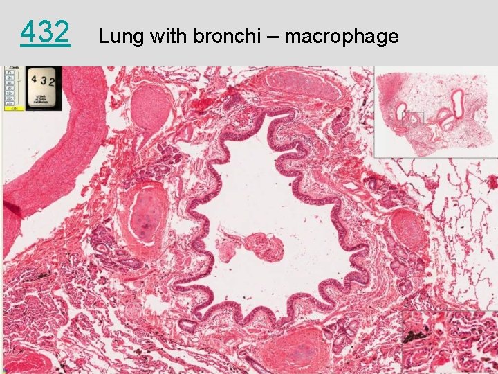 432 Lung with bronchi – macrophage 