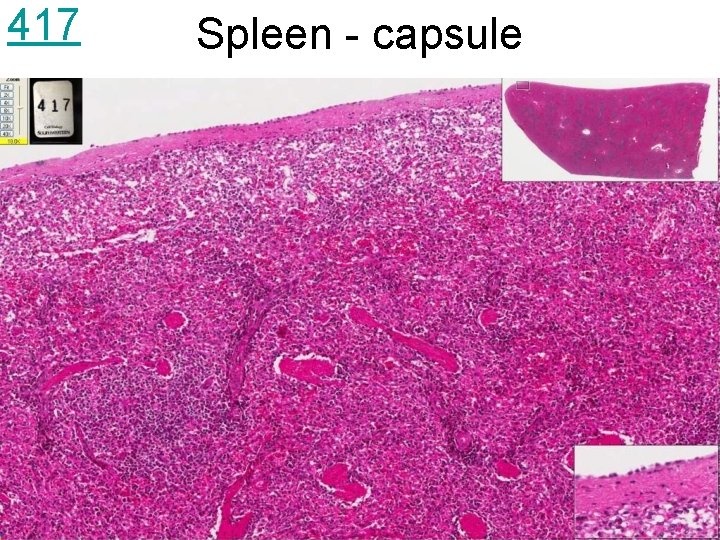 417 Spleen - capsule 