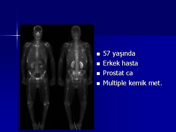 n n 57 yaşında Erkek hasta Prostat ca Multiple kemik met. 