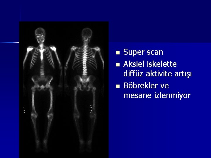 n n n Super scan Aksiel iskelette diffüz aktivite artışı Böbrekler ve mesane izlenmiyor