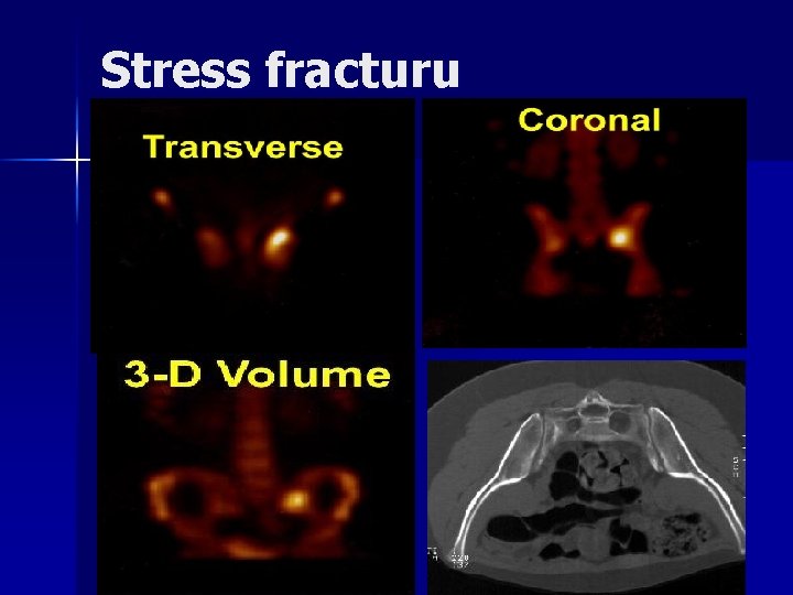 Stress fracturu 