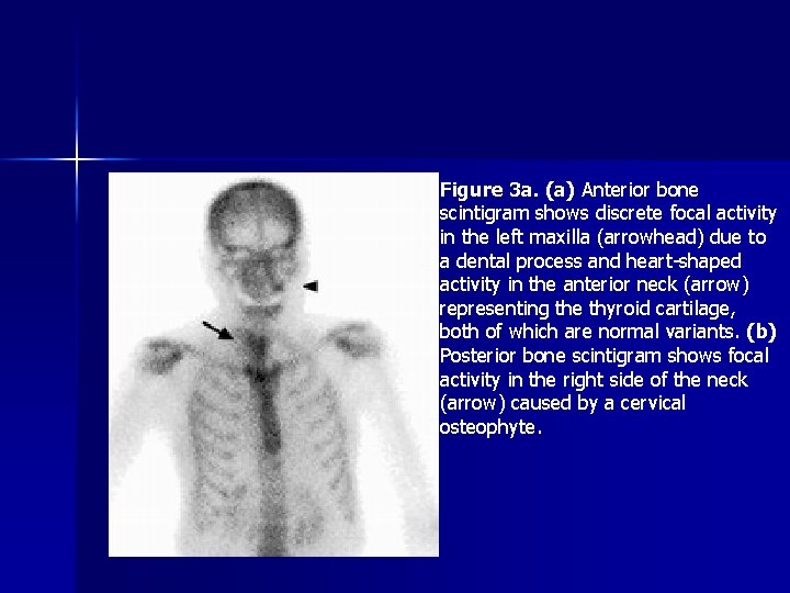 Figure 3 a. (a) Anterior bone scintigram shows discrete focal activity in the left