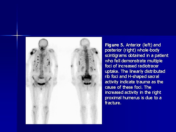 Figure 5. Anterior (left) and posterior (right) whole-body scintigrams obtained in a patient who