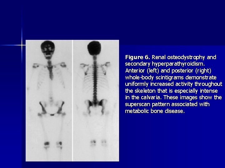 Figure 6. Renal osteodystrophy and secondary hyperparathyroidism. Anterior (left) and posterior (right) whole-body scintigrams