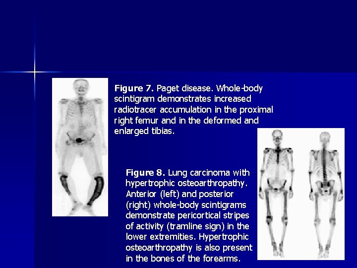 Figure 7. Paget disease. Whole-body scintigram demonstrates increased radiotracer accumulation in the proximal right