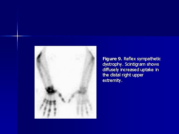 Figure 9. Reflex sympathetic dystrophy. Scintigram shows diffusely increased uptake in the distal right