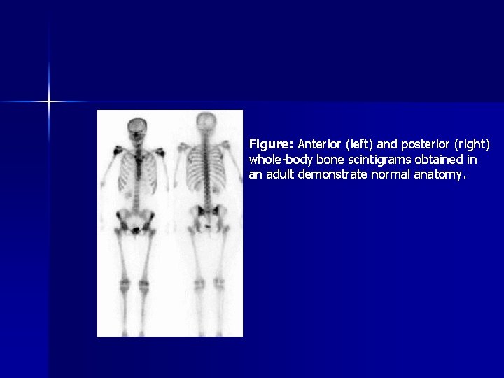 Figure: Anterior (left) and posterior (right) whole-body bone scintigrams obtained in an adult demonstrate