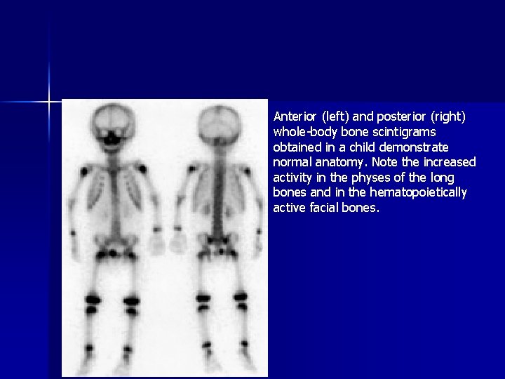 Anterior (left) and posterior (right) whole-body bone scintigrams obtained in a child demonstrate normal