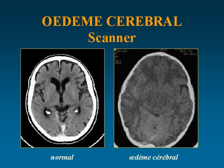 OEDEME CEREBRAL Scanner normal œdème cérébral 