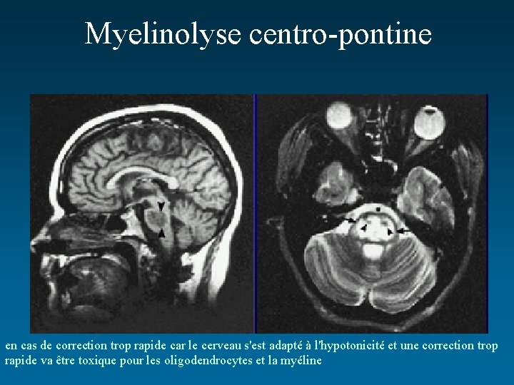 Myelinolyse centro-pontine en cas de correction trop rapide car le cerveau s'est adapté à