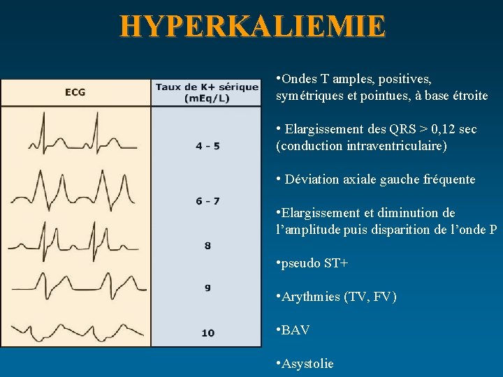 HYPERKALIEMIE • Ondes T amples, positives, symétriques et pointues, à base étroite • Elargissement