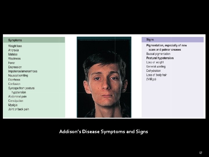 1 Addisons Disease 2 Hypernatremia By Dr Zahoor