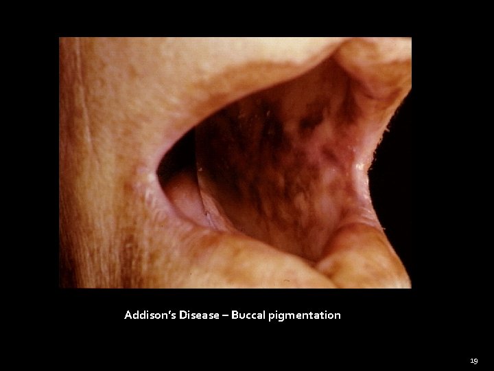 Addison’s Disease – Buccal pigmentation 19 