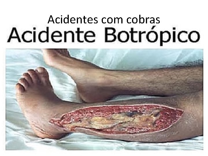 Acidentes com cobras Acidentes com cobras