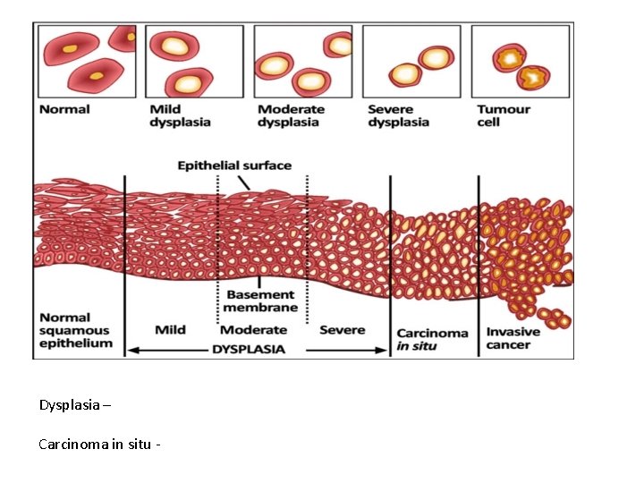 Dysplasia – Carcinoma in situ - Dysplasia – Carcinoma in situ -