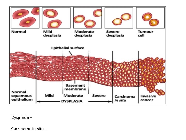 Dysplasia – Carcinoma in situ - 