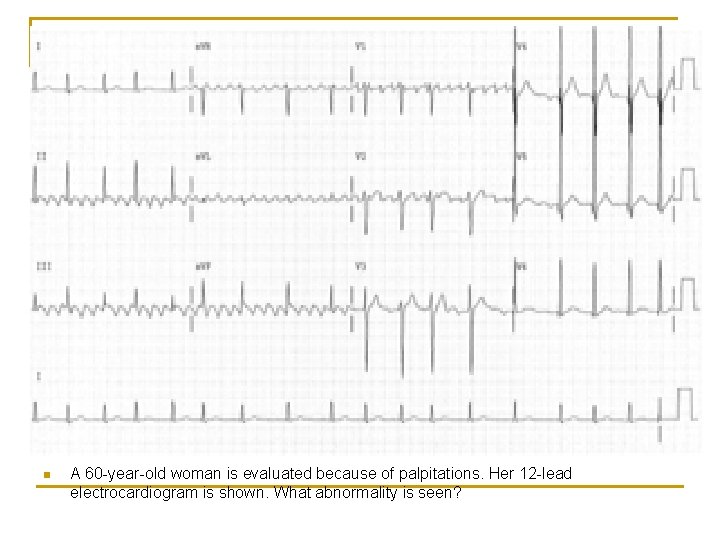 n A 60 -year-old woman is evaluated because of palpitations. Her 12 -lead electrocardiogram