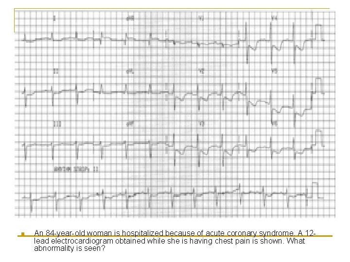 n An 84 -year-old woman is hospitalized because of acute coronary syndrome. A 12