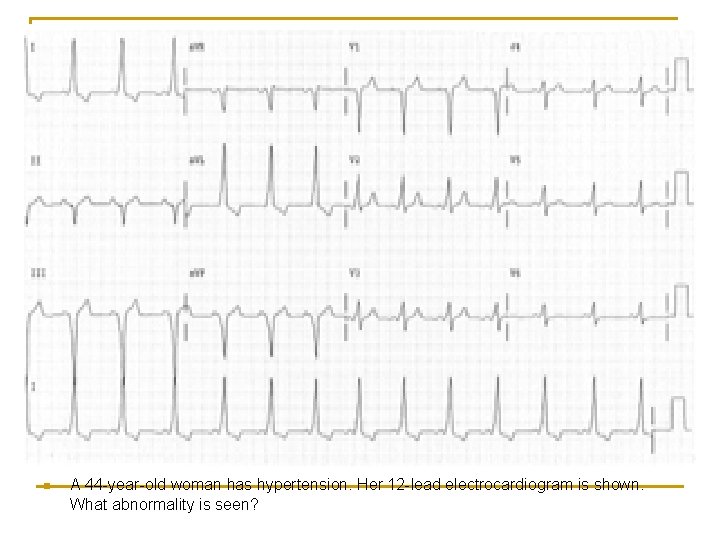 n A 44 -year-old woman has hypertension. Her 12 -lead electrocardiogram is shown. What