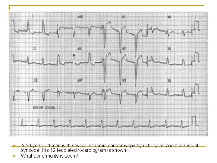 n n A 50 -year-old man with severe ischemic cardiomyopathy is hospitalized because of