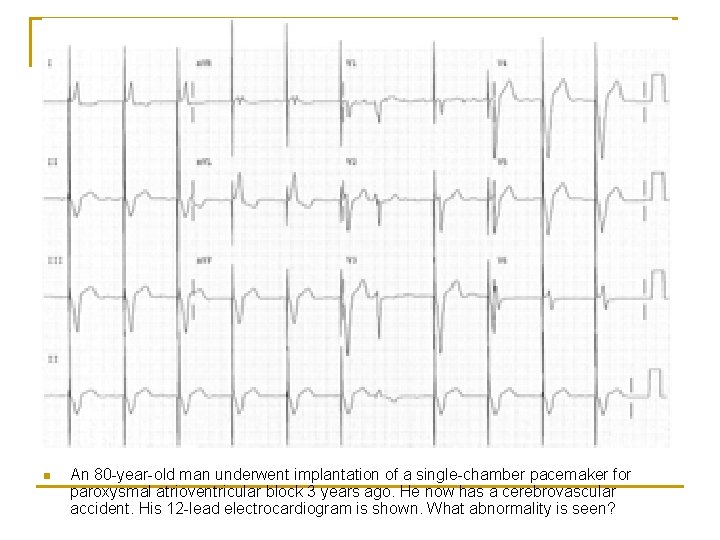 n An 80 -year-old man underwent implantation of a single-chamber pacemaker for paroxysmal atrioventricular