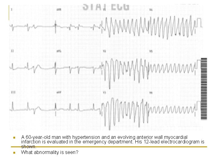 n n A 60 -year-old man with hypertension and an evolving anterior wall myocardial