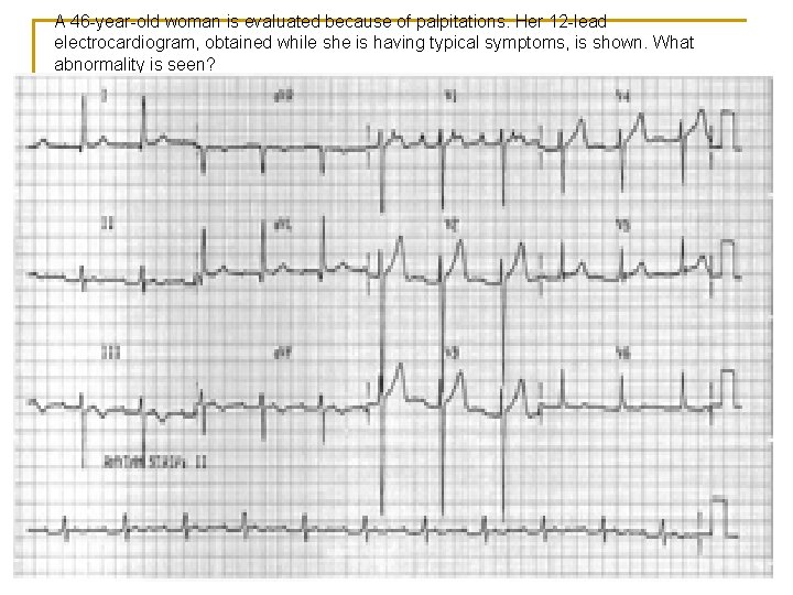 A 46 -year-old woman is evaluated because of palpitations. Her 12 -lead electrocardiogram, obtained