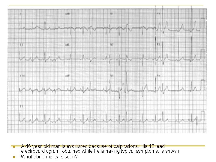 n n A 46 -year-old man is evaluated because of palpitations. His 12 -lead