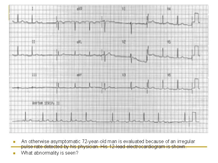 n n An otherwise asymptomatic 72 -year-old man is evaluated because of an irregular