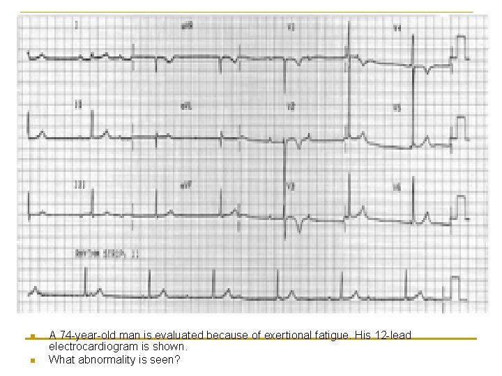 n n A 74 -year-old man is evaluated because of exertional fatigue. His 12