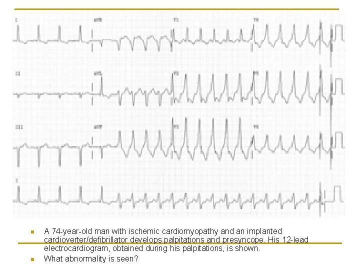 n n A 74 -year-old man with ischemic cardiomyopathy and an implanted cardioverter/defibrillator develops