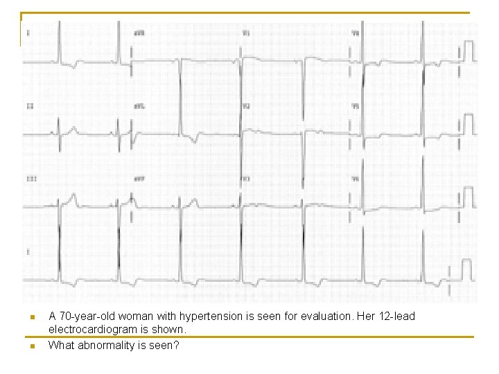 n n A 70 -year-old woman with hypertension is seen for evaluation. Her 12