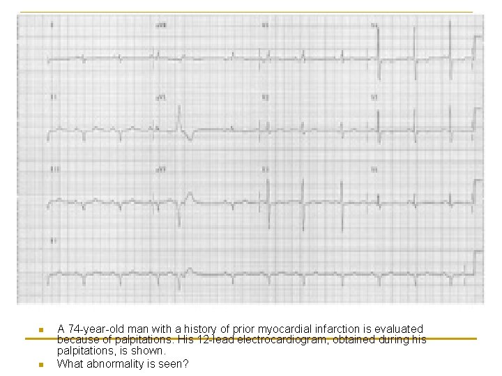 n n A 74 -year-old man with a history of prior myocardial infarction is