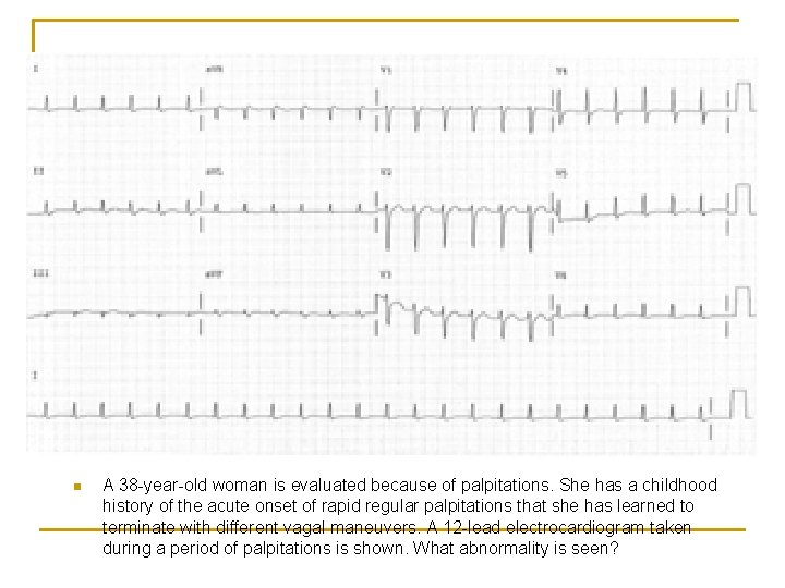 n A 38 -year-old woman is evaluated because of palpitations. She has a childhood