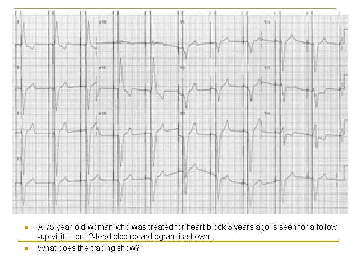 n n A 75 -year-old woman who was treated for heart block 3 years