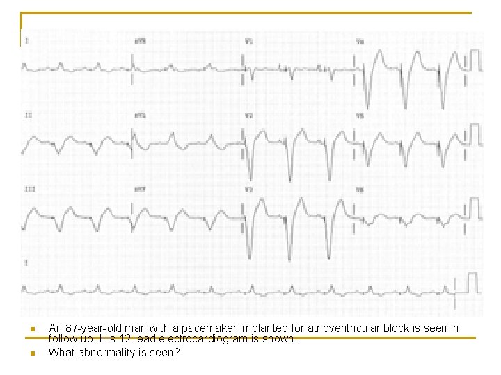 n n An 87 -year-old man with a pacemaker implanted for atrioventricular block is